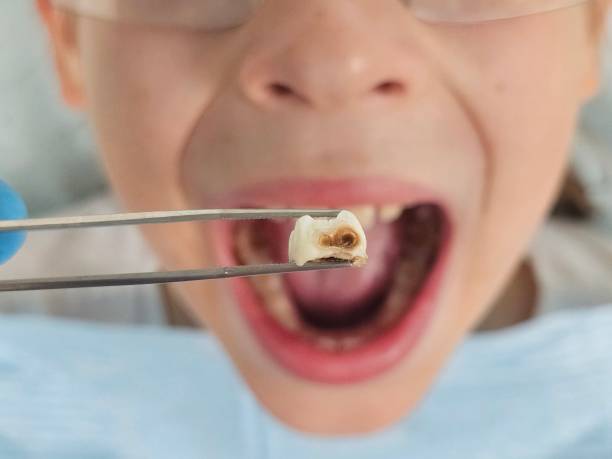 Best Emergency Treatment for Dental Infections or Abscesses in West Long Branch, NJ